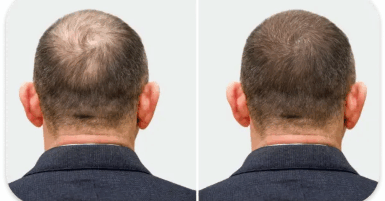 Best Hair Fall Treatment for Men: Complete Guide to Regrowing and Strengthening Your Hair